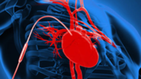 Video: Contacts for heart assist device design